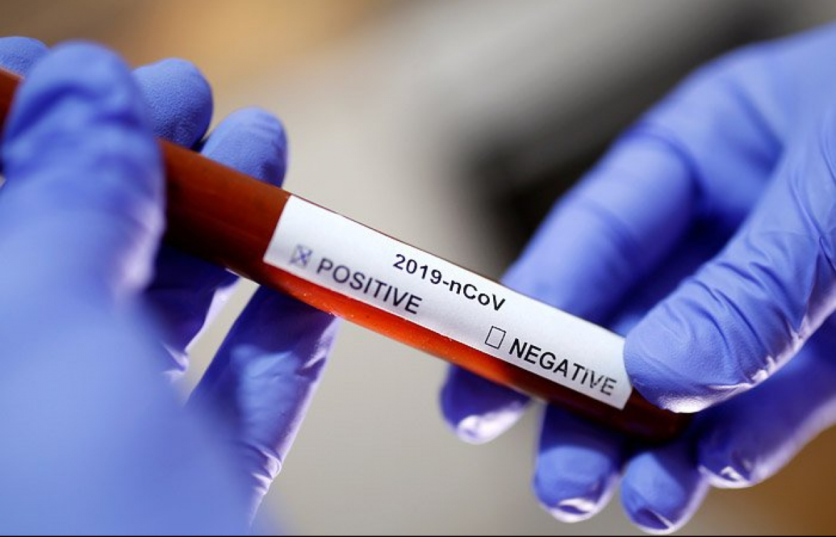 МОЗ закупили понад 19 тисяч швидких тестів на коронавірус