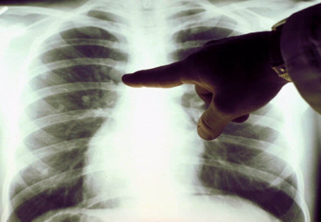 Ранні симптоми раку легень: на що звернути увагу?