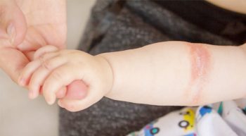 Не варто саджати маму на дієту, якщо у малюка атопічний дерматит — педіатриня Не варто саджати маму на дієту, якщо у малюка атопічний дерматит — педіатриня