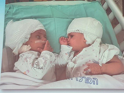 В Ізраїлі успішно роз'єднали сіамських близнючок, з'єднаних у потилиці