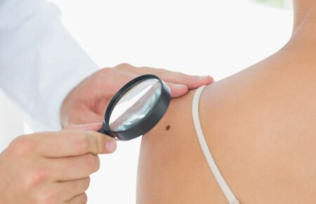 Меланома асоційована із сонячними опіками у будь-якому віці, особливо у дитинстві — дерматологиня