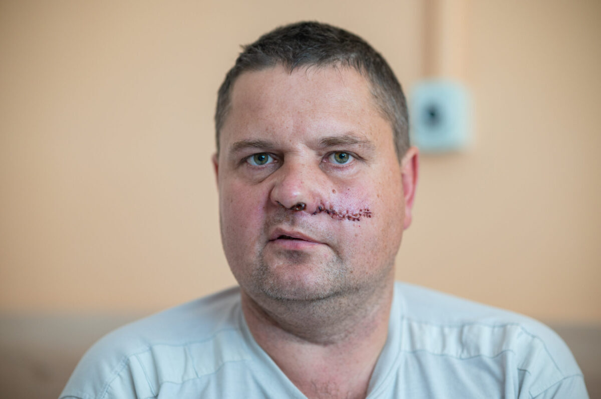 «Снайпер мене дістав» — український боєць розповів про відновлення після поранення в обличчя